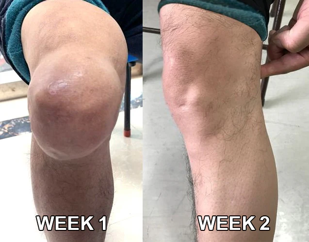 Infiammazione al ginocchio