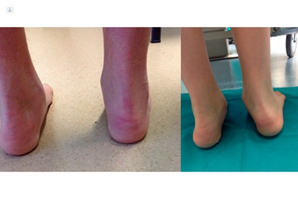 Foto prodotto EasyFoot