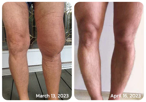 Infiammazione ginocchio