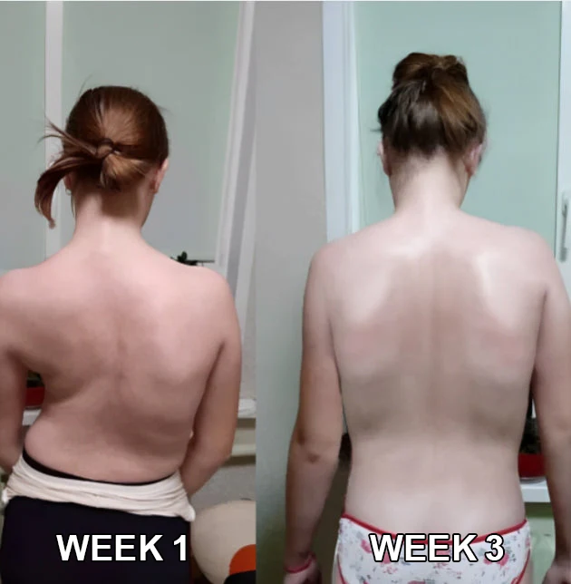 Schiena bloccata infiammazione acuta