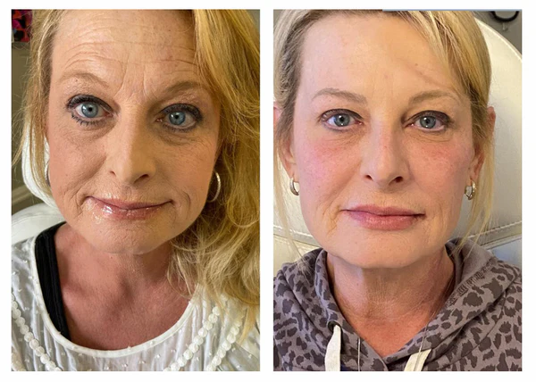 Risultati Veleno di Vipera