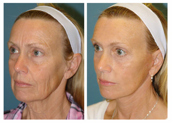 X FILLER Donna - Recensione 2