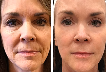 X FILLER Donna - Recensione 1