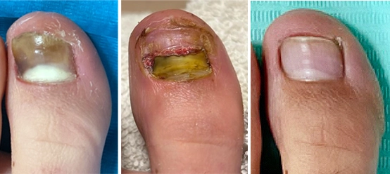 Onicomicosi recensione cliente